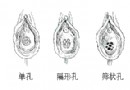 不同形状的处女膜（图）