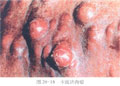 爱滋病的分期及症状[图]