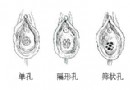 不同形状的处女膜(图)